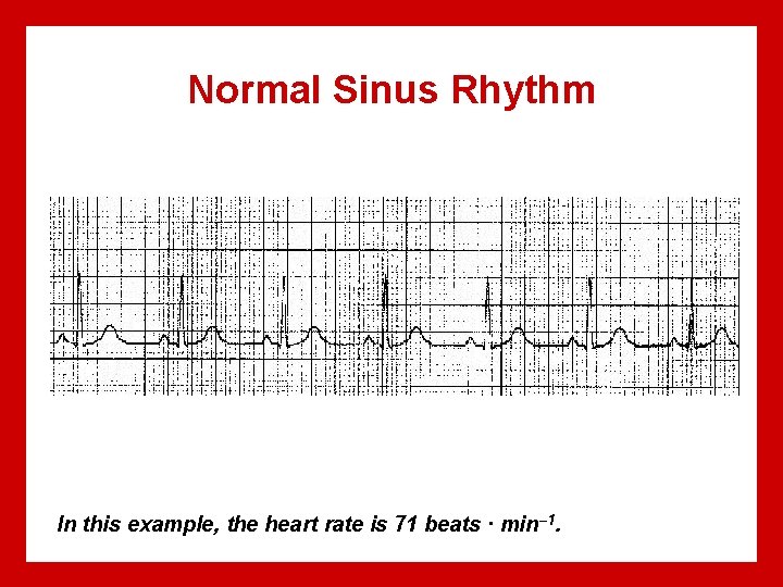 Normal Sinus Rhythm In this example, the heart rate is 71 beats · min–