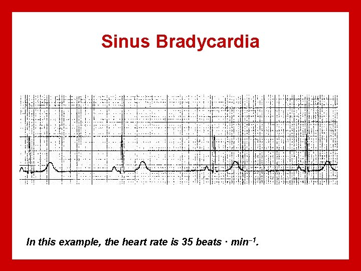 Sinus Bradycardia In this example, the heart rate is 35 beats · min– 1.