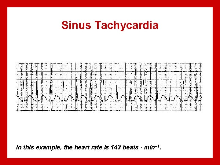 Sinus Tachycardia In this example, the heart rate is 143 beats · min– 1.