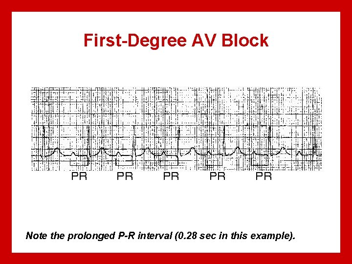 First-Degree AV Block Note the prolonged P-R interval (0. 28 sec in this example).