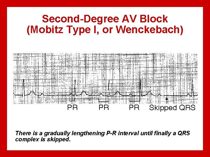 Second-Degree AV Block (Mobitz Type I, or Wenckebach) There is a gradually lengthening P-R