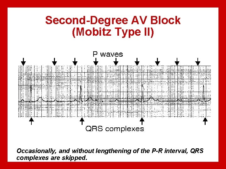Second-Degree AV Block (Mobitz Type II) Occasionally, and without lengthening of the P-R interval,