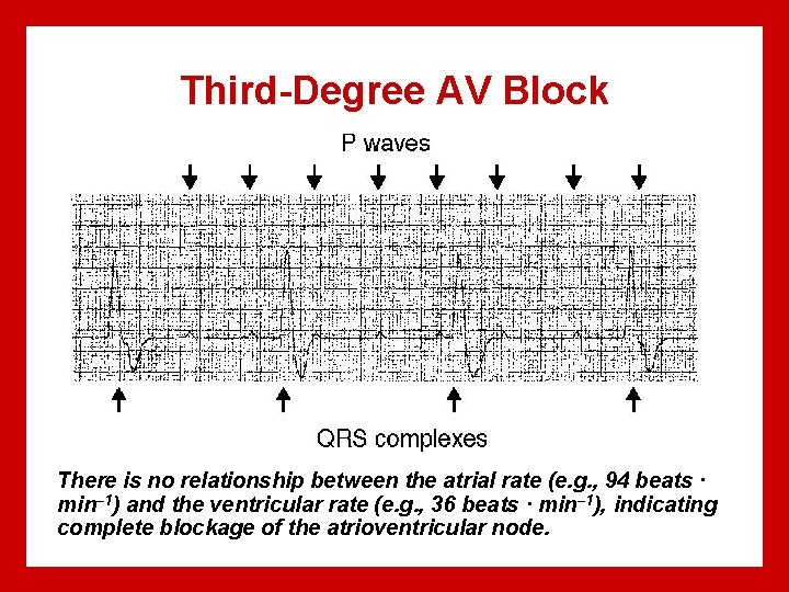 Third-Degree AV Block There is no relationship between the atrial rate (e. g. ,