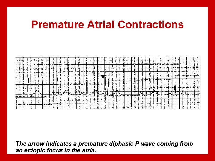 Premature Atrial Contractions The arrow indicates a premature diphasic P wave coming from an