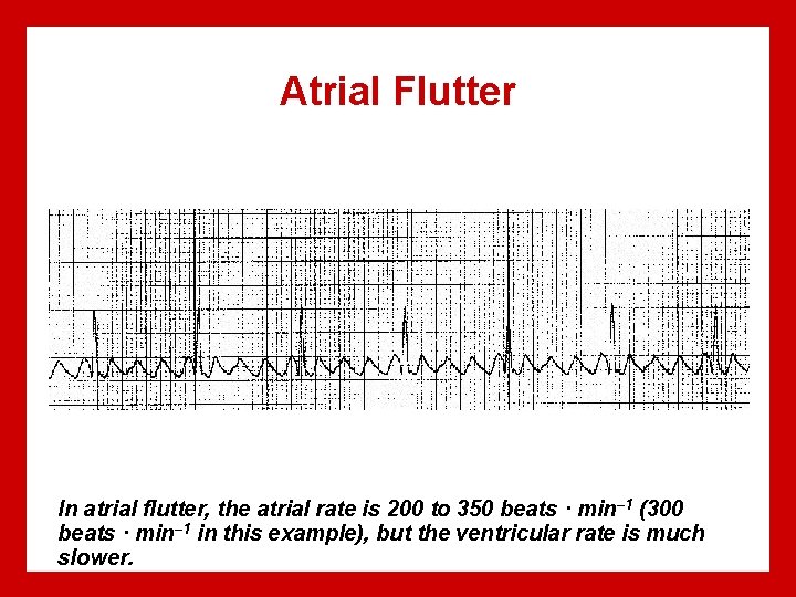 Atrial Flutter In atrial flutter, the atrial rate is 200 to 350 beats ·