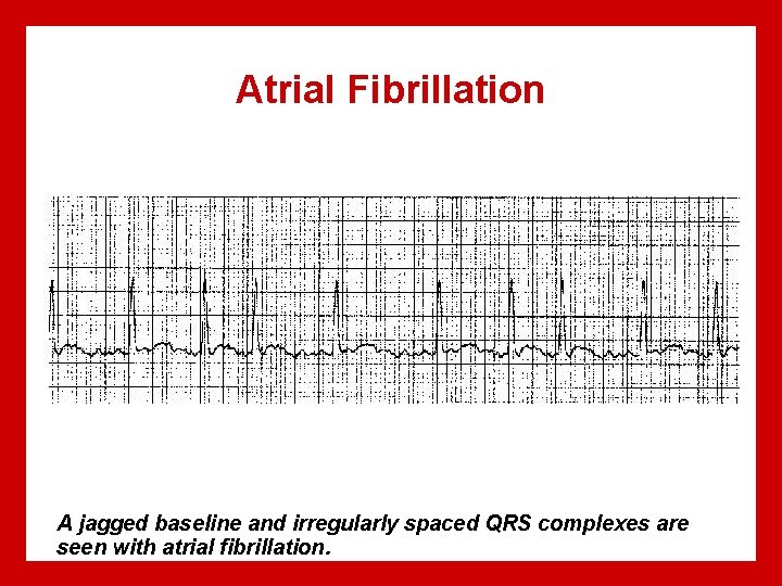 Atrial Fibrillation A jagged baseline and irregularly spaced QRS complexes are seen with atrial