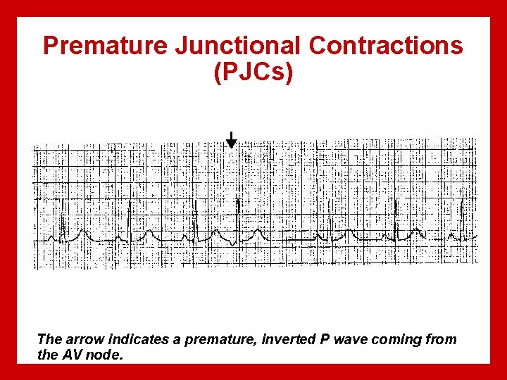 Premature Junctional Contractions (PJCs) The arrow indicates a premature, inverted P wave coming from