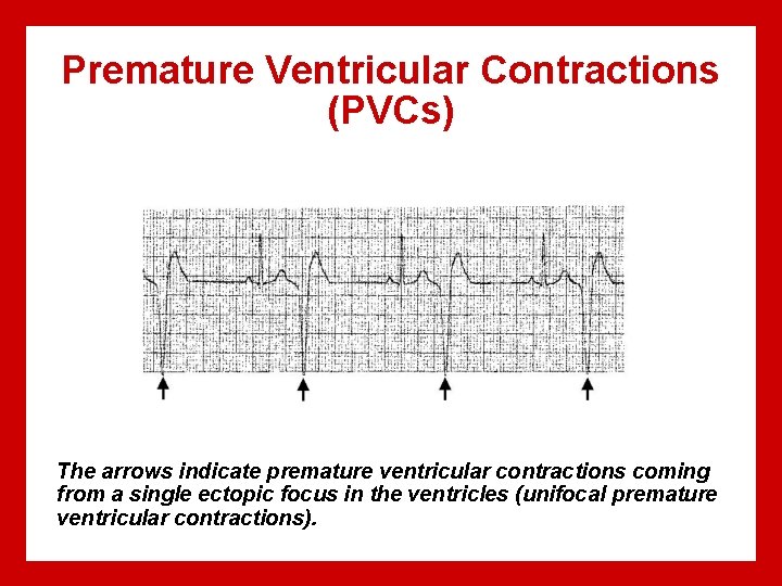 Premature Ventricular Contractions (PVCs) The arrows indicate premature ventricular contractions coming from a single