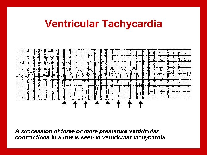 Ventricular Tachycardia A succession of three or more premature ventricular contractions in a row