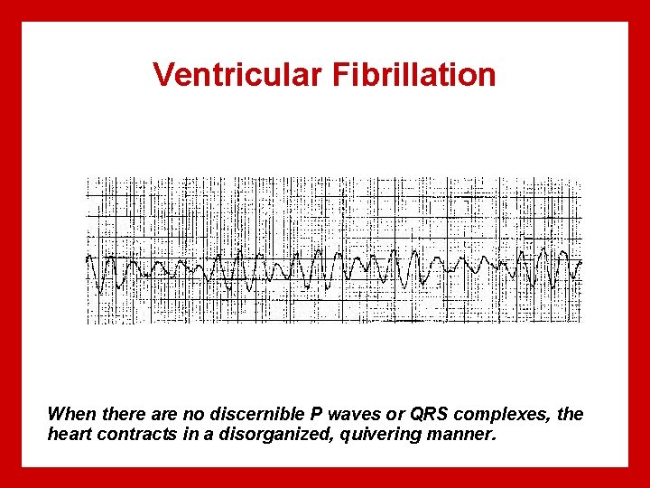 Ventricular Fibrillation When there are no discernible P waves or QRS complexes, the heart