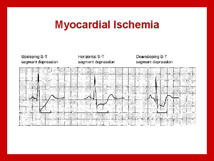 Myocardial Ischemia 