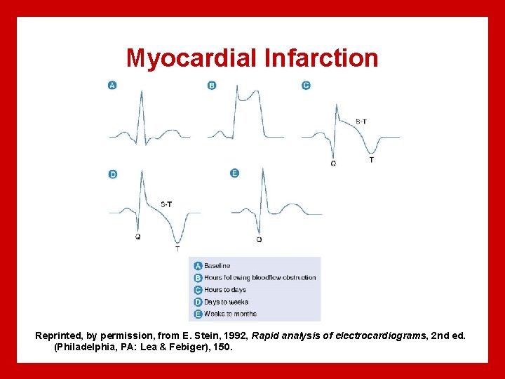 Myocardial Infarction Reprinted, by permission, from E. Stein, 1992, Rapid analysis of electrocardiograms, 2