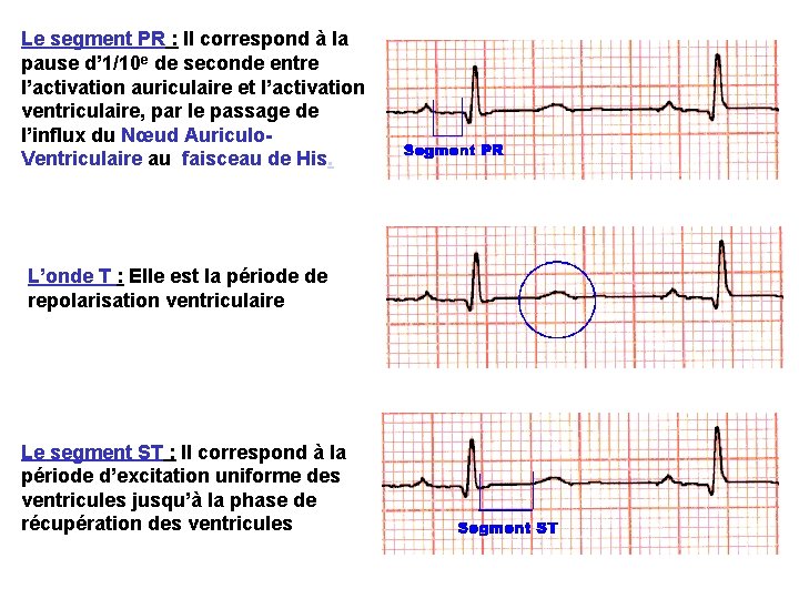 Le segment PR : Il correspond à la pause d’ 1/10 e de seconde