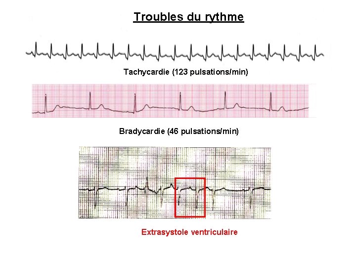 Troubles du rythme Tachycardie (123 pulsations/min) Bradycardie (46 pulsations/min) Extrasystole ventriculaire 