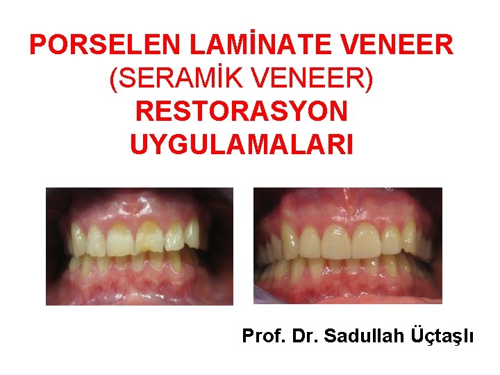 PORSELEN LAMİNATE VENEER (SERAMİK VENEER) RESTORASYON UYGULAMALARI Prof. Dr. Sadullah Üçtaşlı 