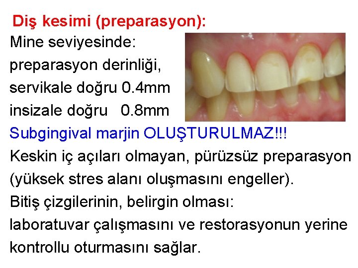 Diş kesimi (preparasyon): Mine seviyesinde: preparasyon derinliği, servikale doğru 0. 4 mm insizale doğru