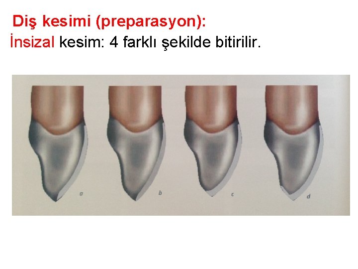Diş kesimi (preparasyon): İnsizal kesim: 4 farklı şekilde bitirilir. Diş kesimi (preparasyon): İnsizal kesim: 4 farklı şekilde bitirilir.
