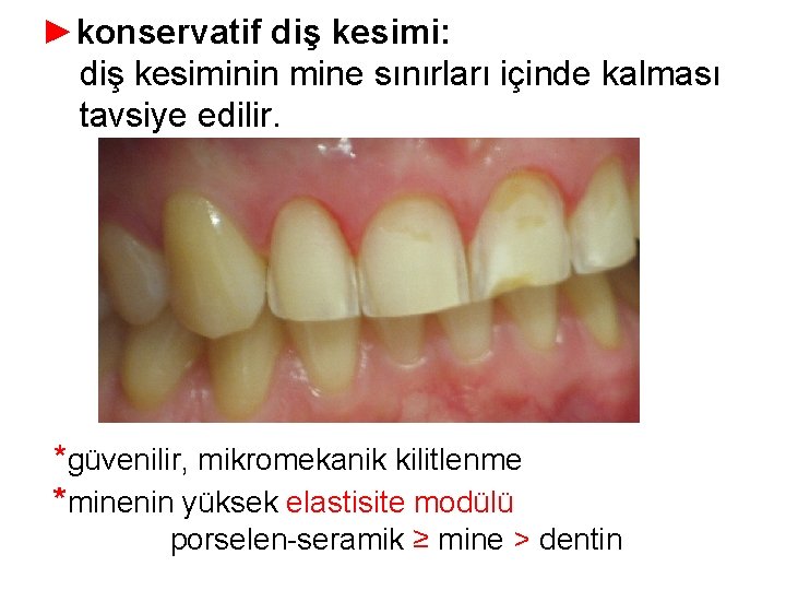 ►konservatif diş kesimi: diş kesiminin mine sınırları içinde kalması tavsiye edilir. *güvenilir, mikromekanik kilitlenme