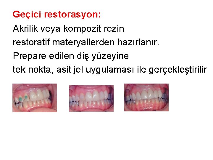 Geçici restorasyon: Akrilik veya kompozit rezin restoratif materyallerden hazırlanır. Prepare edilen diş yüzeyine tek