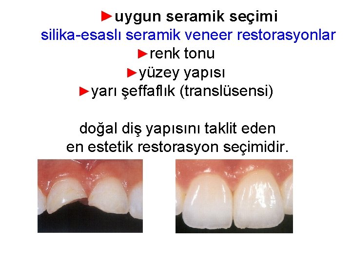 ►uygun seramik seçimi silika-esaslı seramik veneer restorasyonlar ►renk tonu ►yüzey yapısı ►yarı şeffaflık (translüsensi)