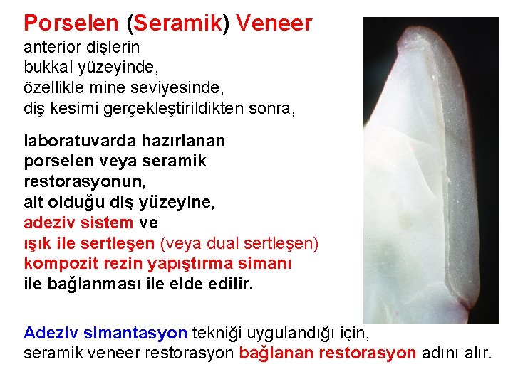 Porselen (Seramik) Veneer anterior dişlerin bukkal yüzeyinde, özellikle mine seviyesinde, diş kesimi gerçekleştirildikten sonra,