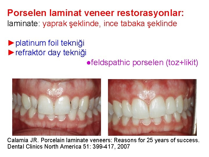 Porselen laminat veneer restorasyonlar: laminate: yaprak şeklinde, ince tabaka şeklinde ►platinum foil tekniği ►refraktör