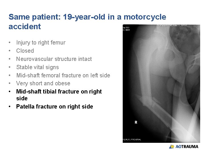 Same patient: 19 -year-old in a motorcycle accident • • Injury to right femur