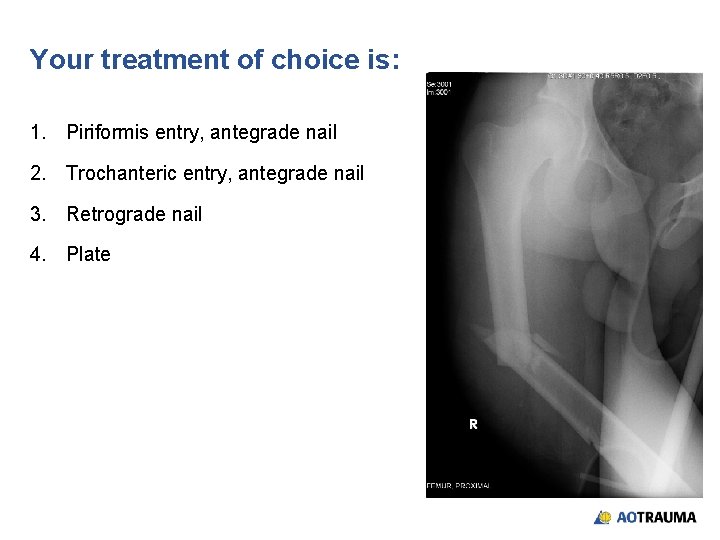 Your treatment of choice is: 1. Piriformis entry, antegrade nail 2. Trochanteric entry, antegrade