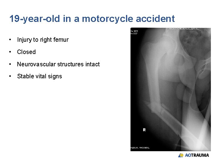 19 -year-old in a motorcycle accident • Injury to right femur • Closed •