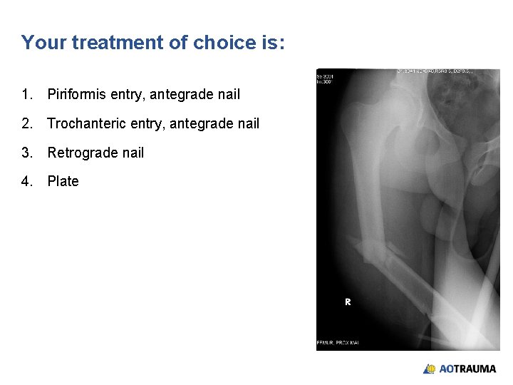 Your treatment of choice is: 1. Piriformis entry, antegrade nail 2. Trochanteric entry, antegrade