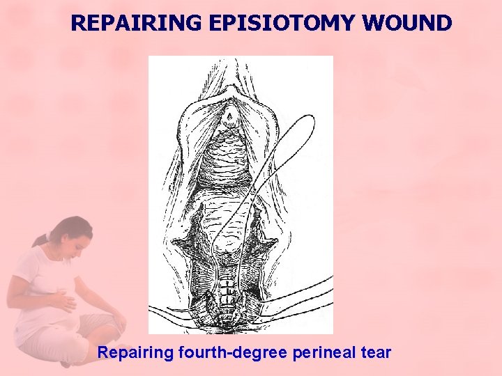 REPAIRING EPISIOTOMY WOUND Repairing fourth-degree perineal tear 