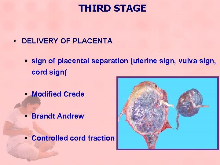 THIRD STAGE • DELIVERY OF PLACENTA § sign of placental separation (uterine sign, vulva