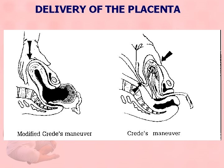 DELIVERY OF THE PLACENTA 