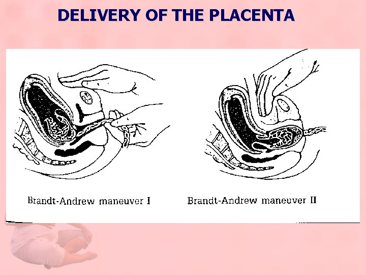 DELIVERY OF THE PLACENTA 