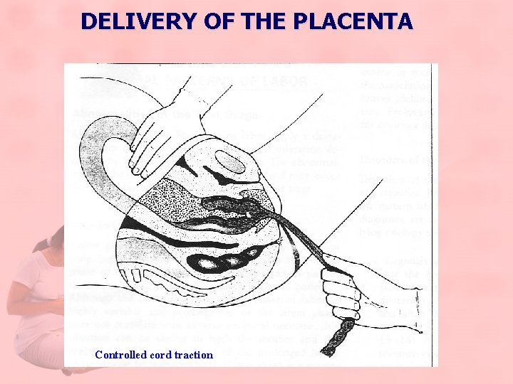 DELIVERY OF THE PLACENTA Controlled cord traction 
