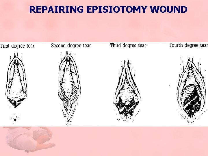 REPAIRING EPISIOTOMY WOUND 