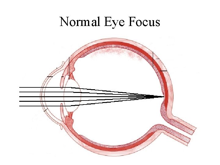 Normal Eye Focus 