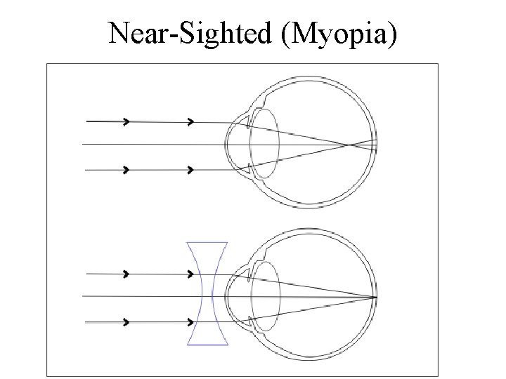 Near-Sighted (Myopia) 