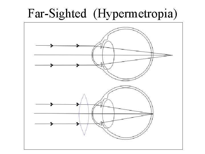 Far-Sighted (Hypermetropia) 