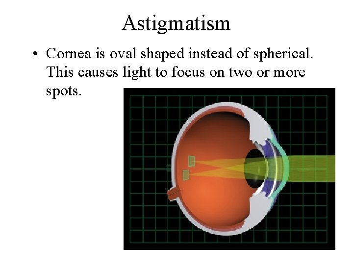 Astigmatism • Cornea is oval shaped instead of spherical. This causes light to focus