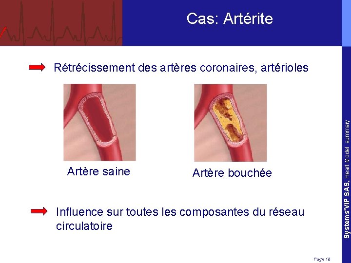Cas: Artérite Artère saine Systems'Vi. P SAS, Heart Model summary Rétrécissement des artères coronaires,