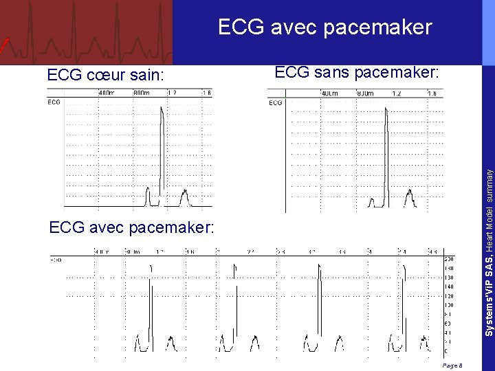 ECG avec pacemaker ECG sans pacemaker: Systems'Vi. P SAS, Heart Model summary ECG cœur