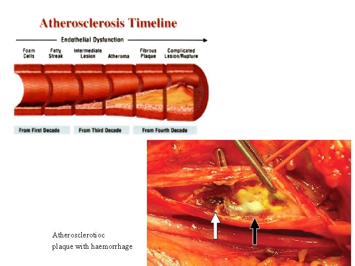 Atherosclerotioc plaque with haemorrhage 