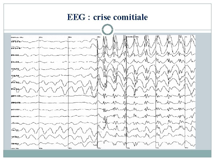 EEG : crise comitiale 
