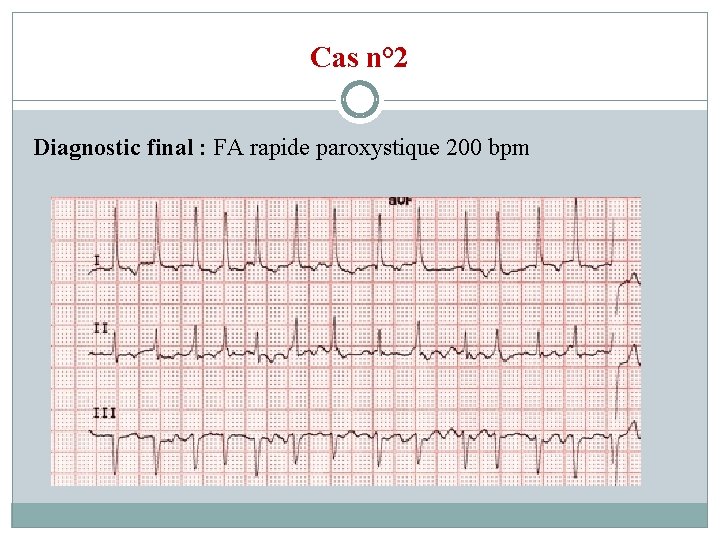 Cas n° 2 Diagnostic final : FA rapide paroxystique 200 bpm 