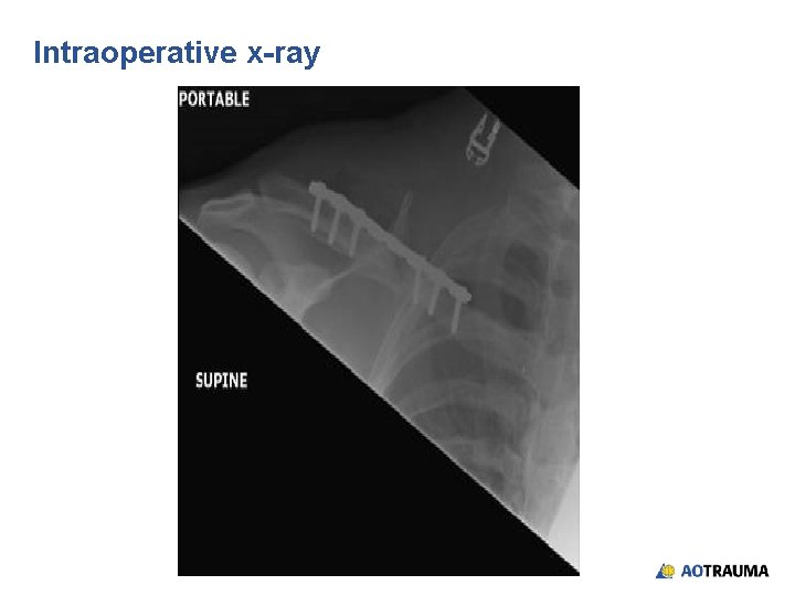 Intraoperative x-ray 