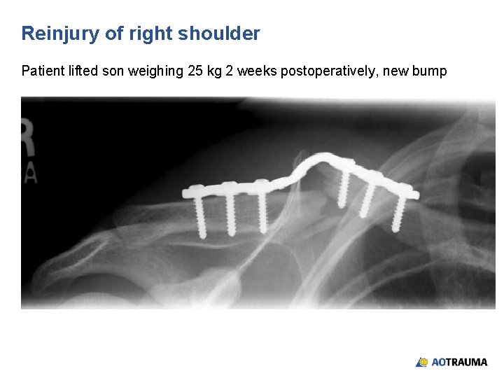Reinjury of right shoulder Patient lifted son weighing 25 kg 2 weeks postoperatively, new