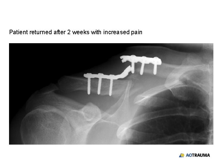 Patient returned after 2 weeks with increased pain 
