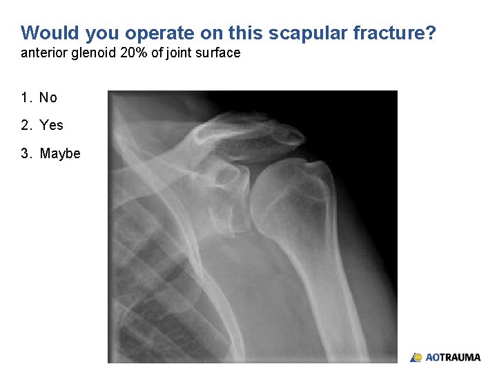 Would you operate on this scapular fracture? anterior glenoid 20% of joint surface 1.