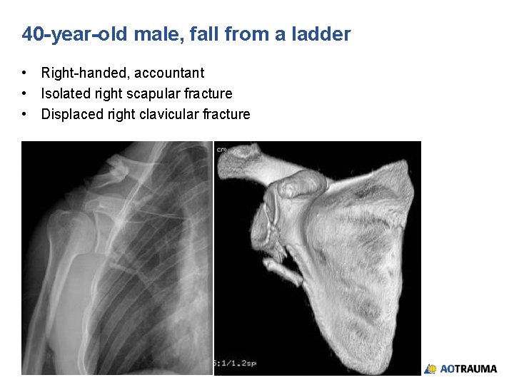 40 -year-old male, fall from a ladder • Right-handed, accountant • Isolated right scapular